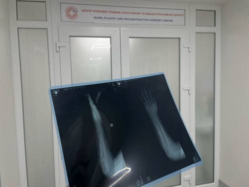 “Хвороба-хамелеон”. У Львові дитині реконструювали 4 см кістки, знищеної інфекцією після запалення&hellip;